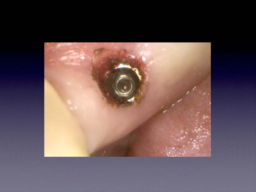 Implant Uncovering