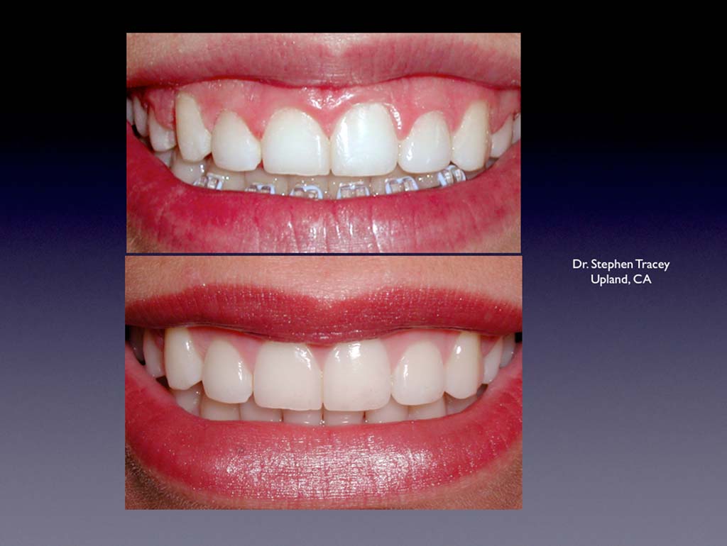 Gingival Recontouring